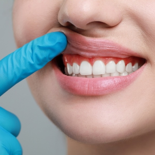 Gum Grafts - BluSky Dental Ottawa